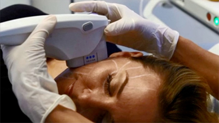 Ultherapy treats the deep layers of skin tissue without disturbing the surface of the skin Ultherapy Treatment
